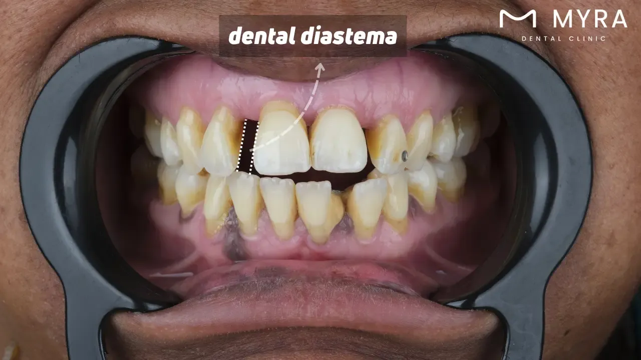 What is diastema?