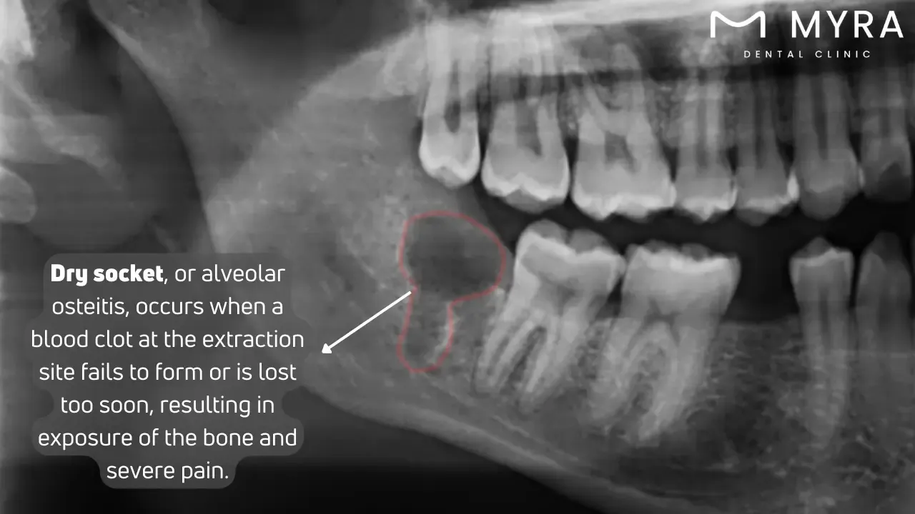What is dry socket?