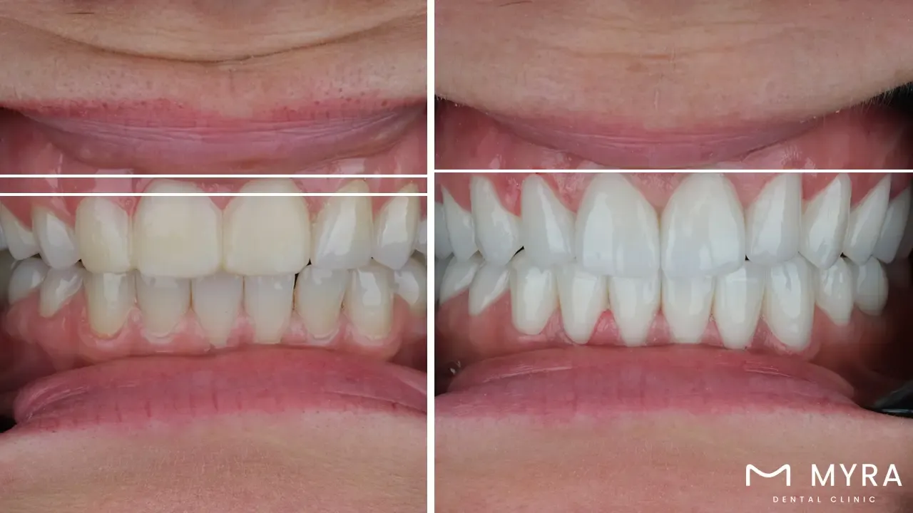 What is the gingival margin?