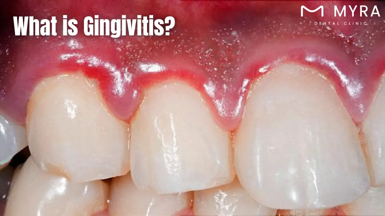 What is gingivitis in turkey?