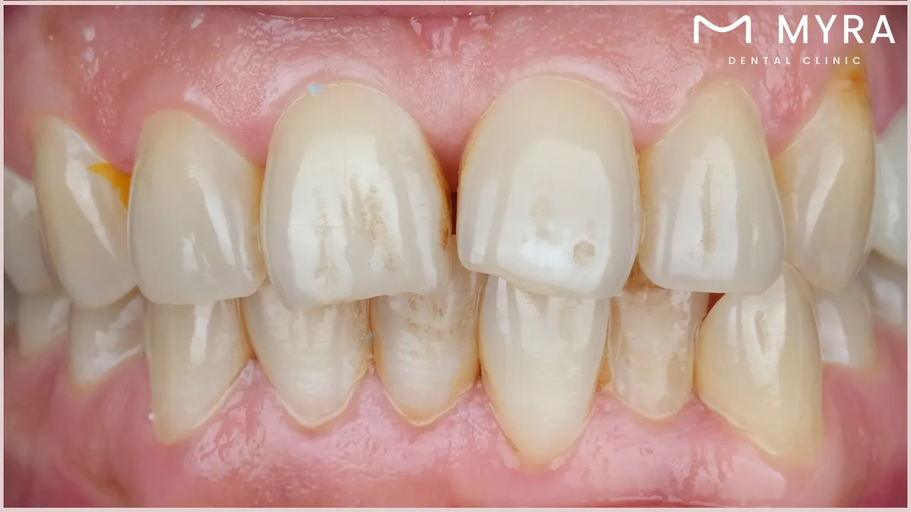 what is malocclusion of the teeth?