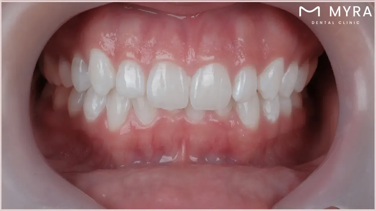 What is teeth whitening?
