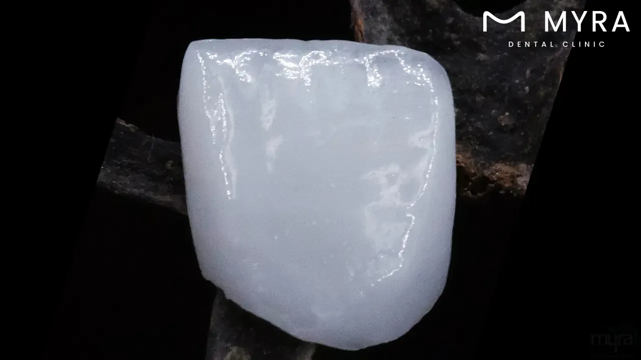 What is the anatomy of maxillary central incisors?