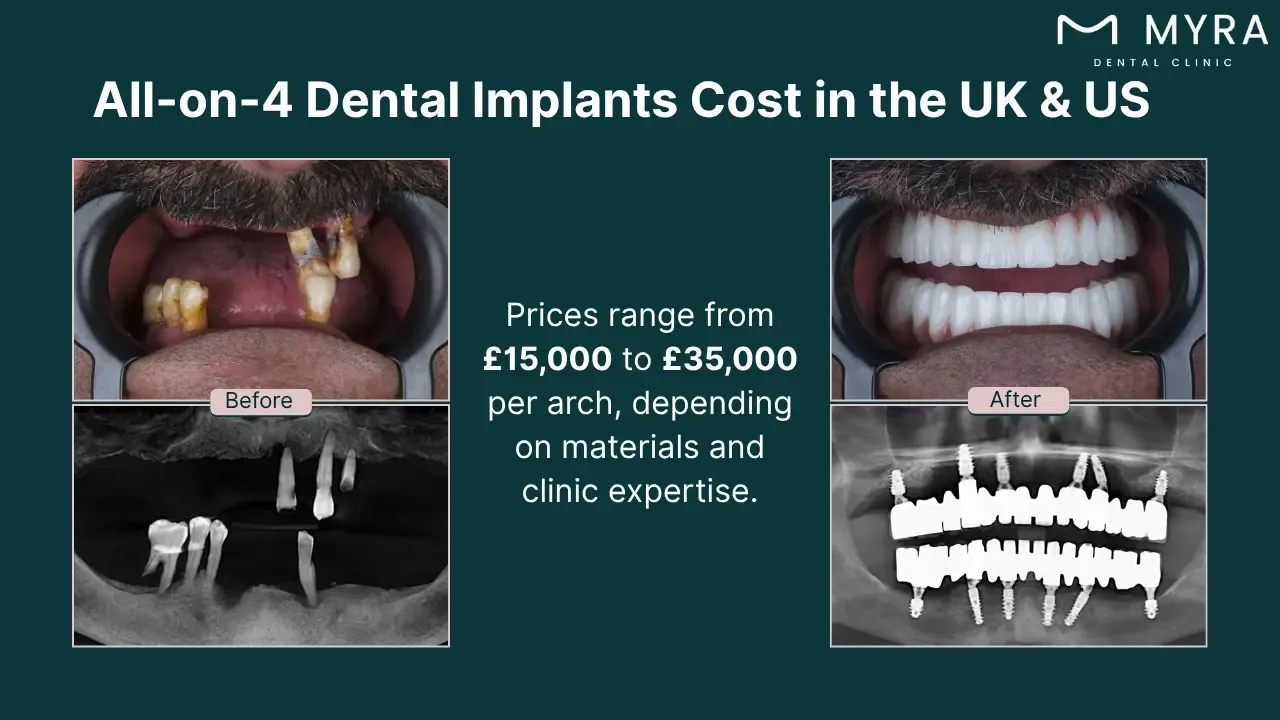 what is the average cost for all-on-4 dental implants?