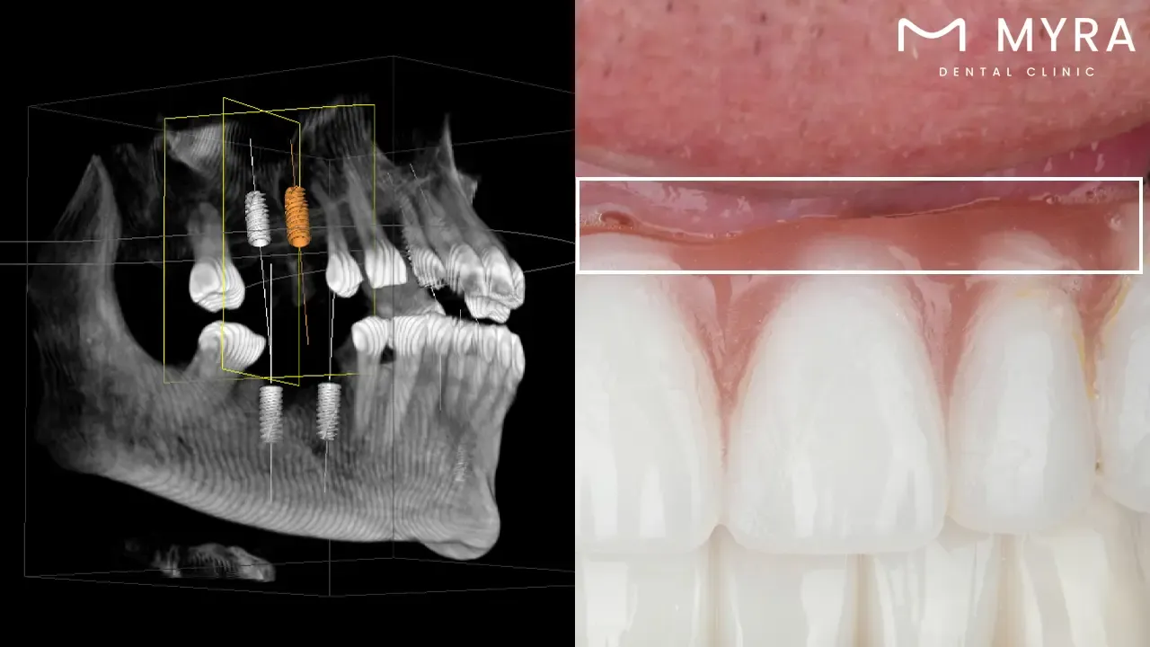 What is the difference between a denture and an implant?