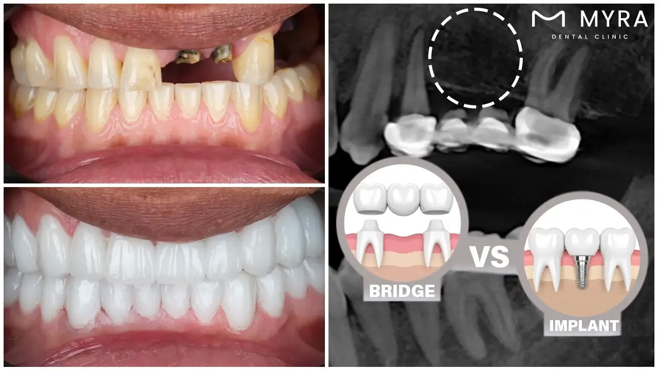 what is the difference between a single tooth dental implant and a bridge