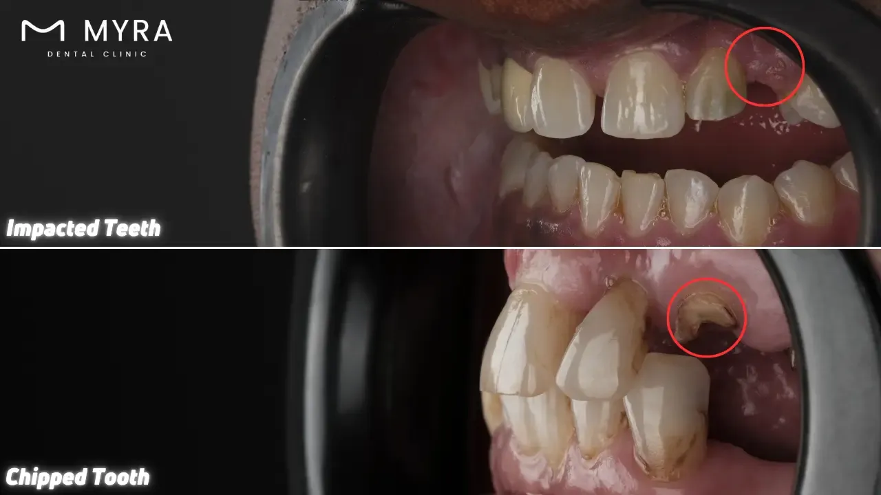 What is the difference between an impacted tooth and a chipped tooth?
