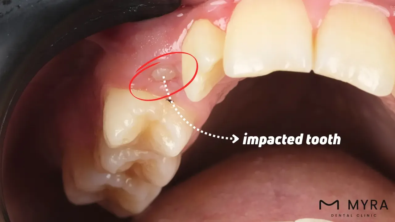 What is the difference between cold-sensitive teeth and impacted teeth?