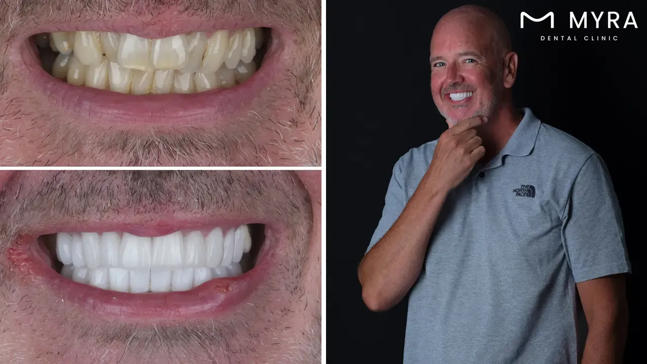 What is the effect of a narrow smile?