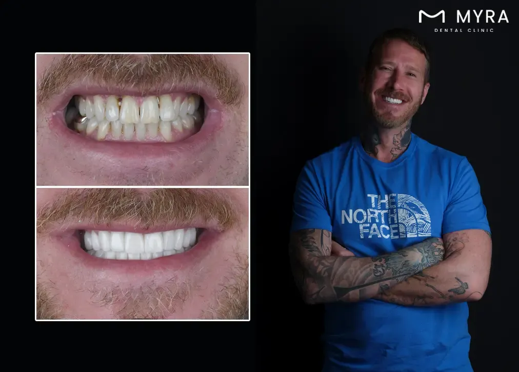 What is the emax dental crown cost