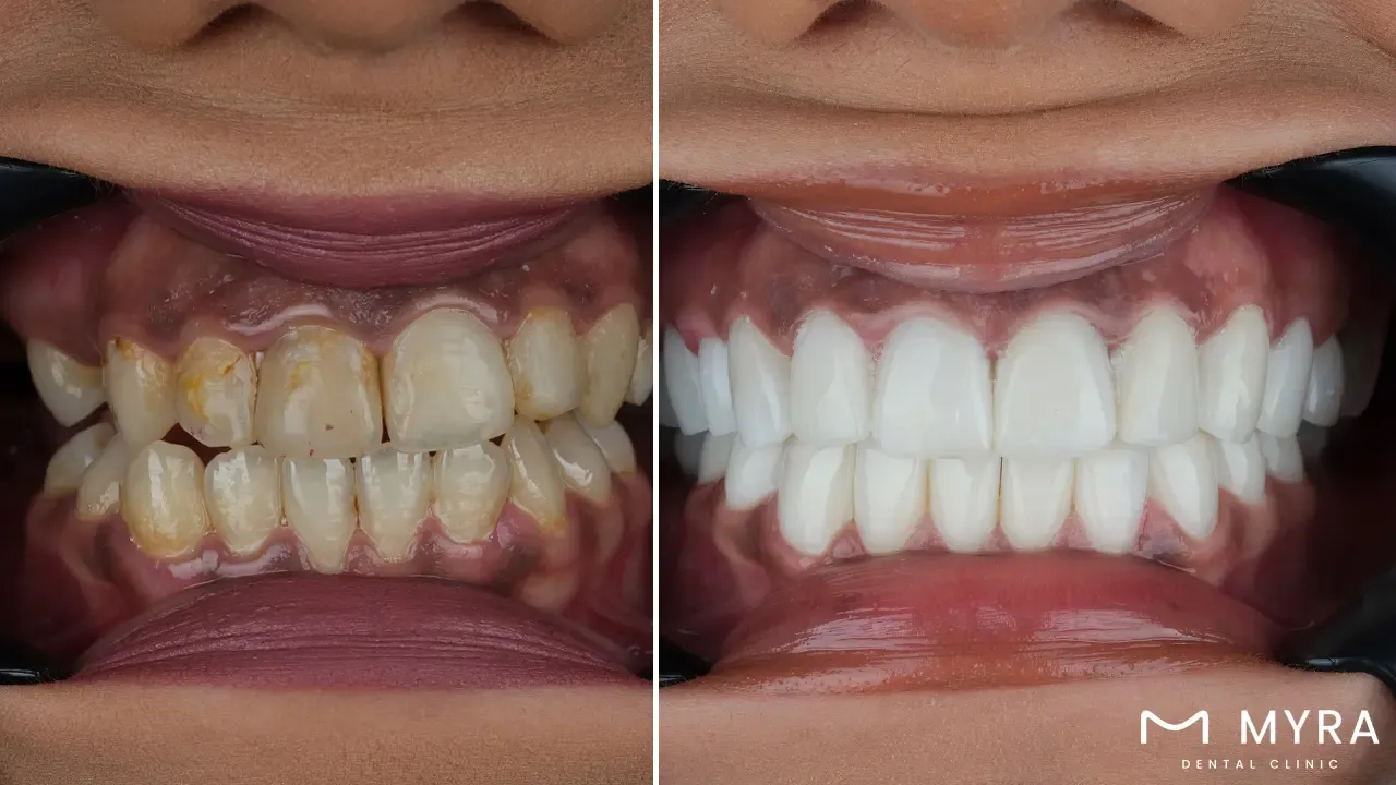 What is the function of the gingival margins?