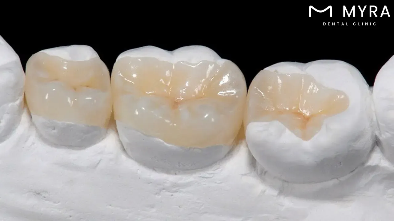 what is the importance of inlays?