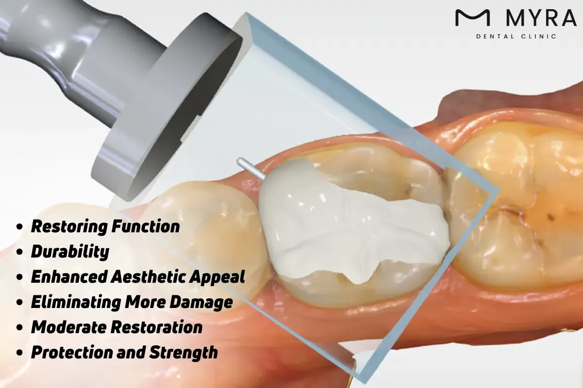 What is the importance of onlays?