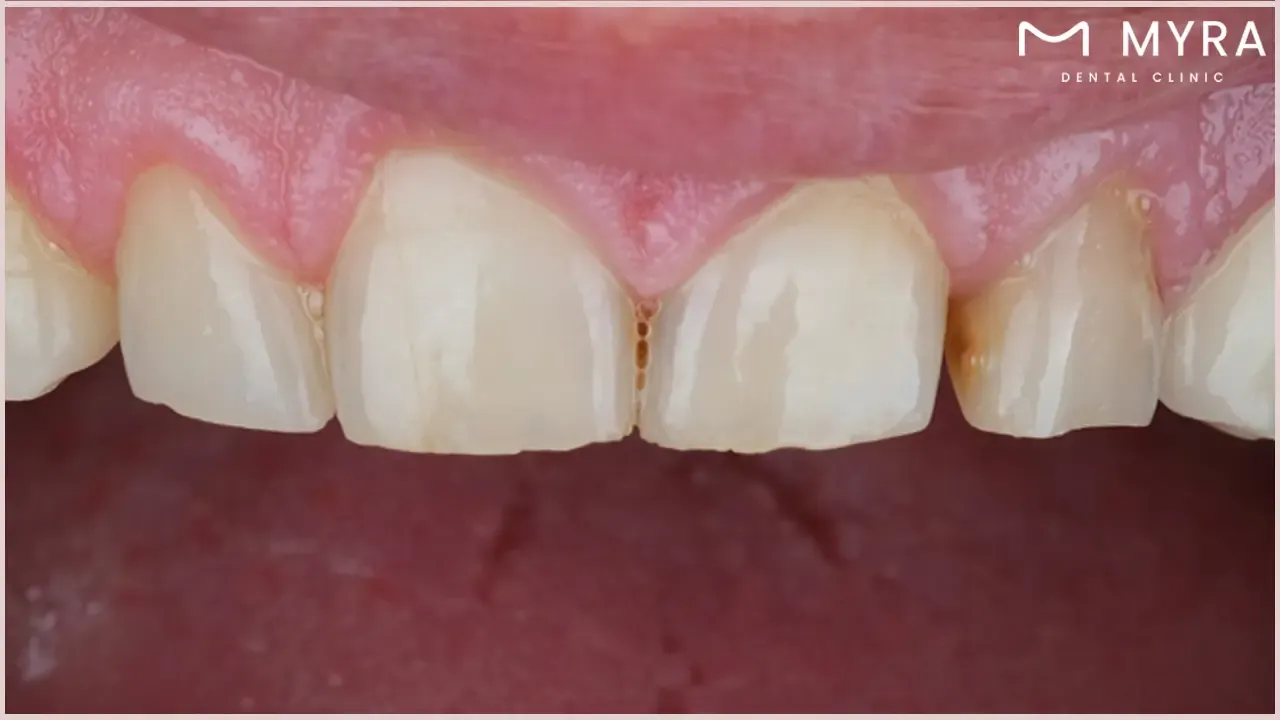 What is the importance of teeth whitening?