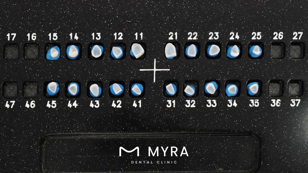 What is the most expensive type of dental veneers