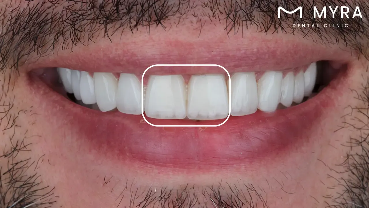 What is the position of maxillary central incisors?