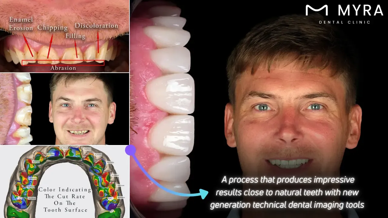 What is the procedure for dental veneers