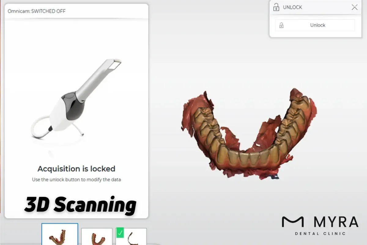 What is the procedure for onlays?
