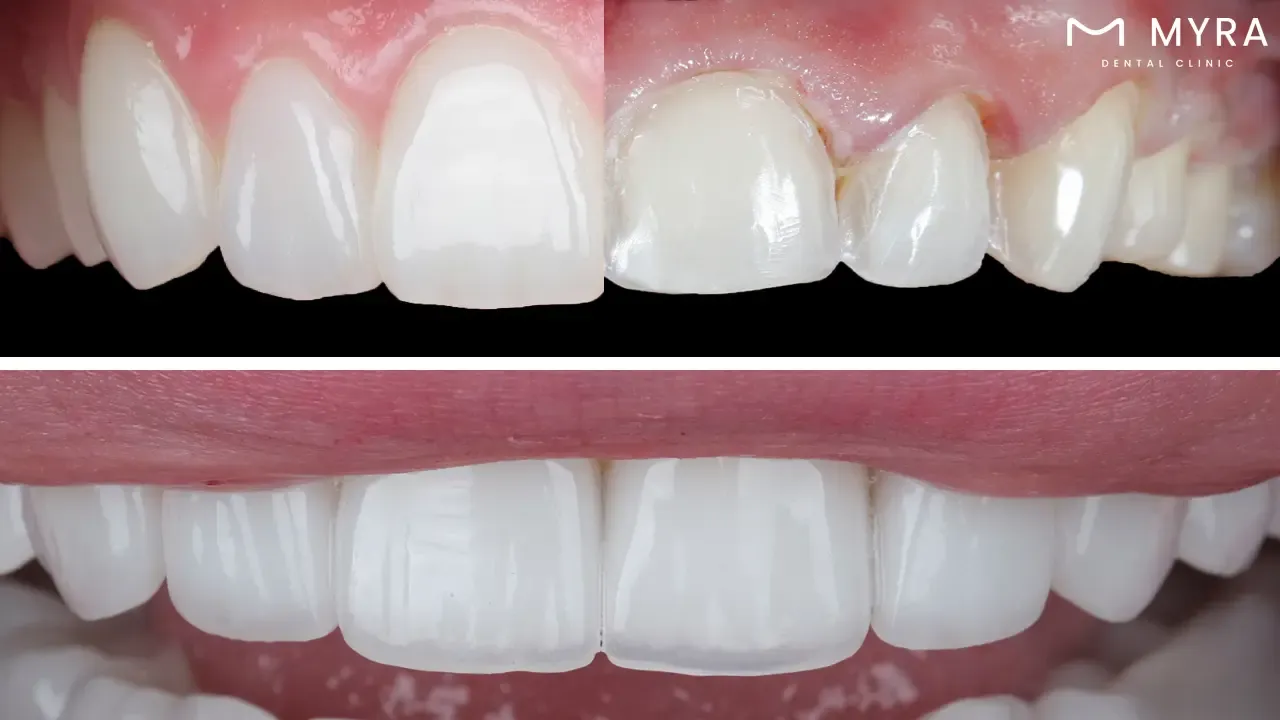 What is the process of getting dental veneers?