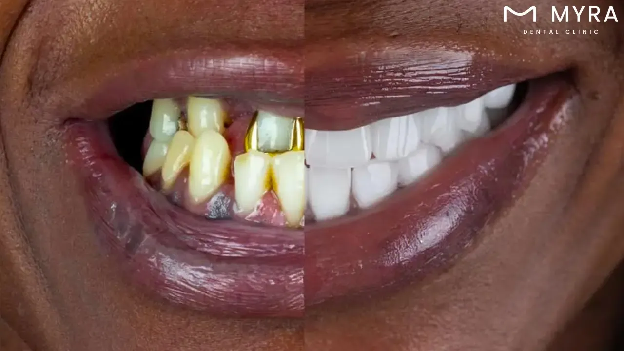 what is the recommended interval for implant maintenance?