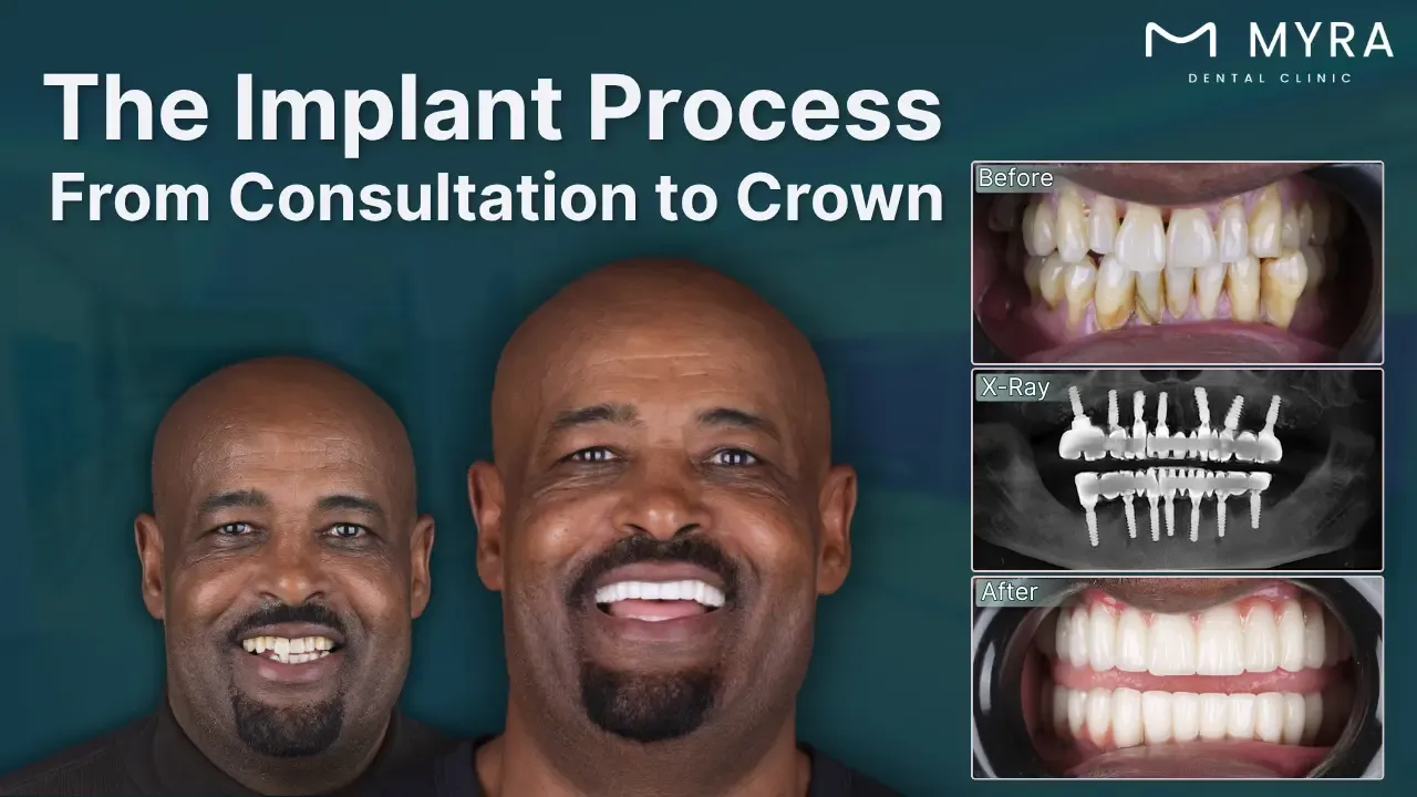 what is the tooth implant treatment process?