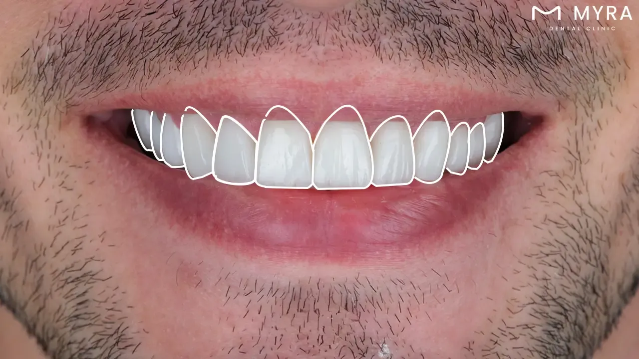 What is the usual quantity of dental veneers needed