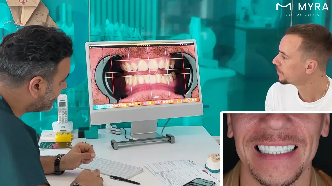  What should patients consider when discussing veneer quantity with their dentist