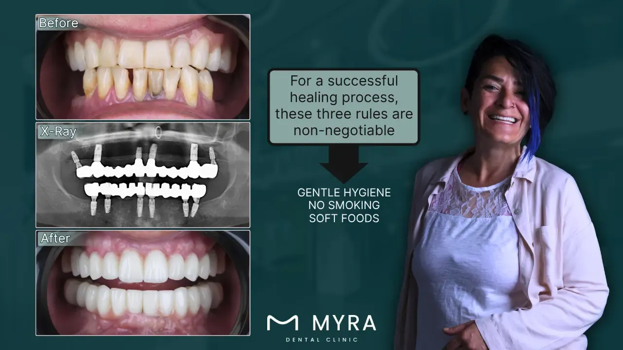 what to do after a dental implant surgery