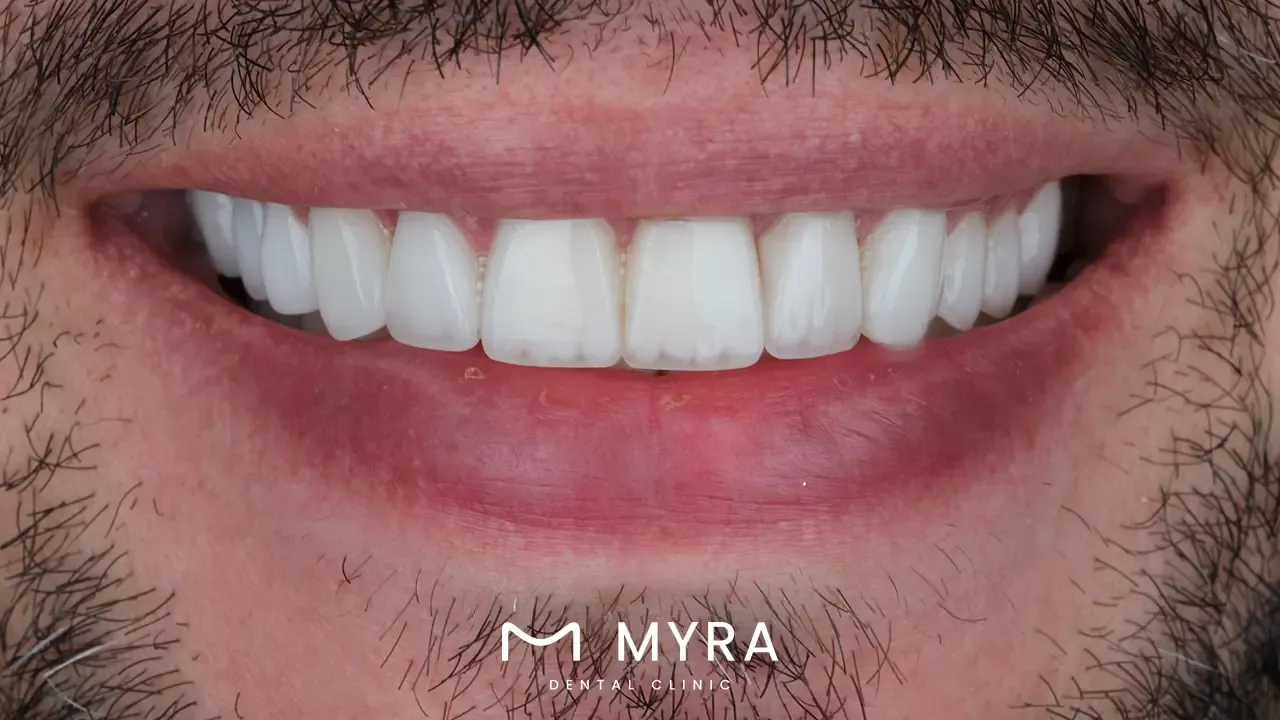 what to do before and after having dental implants