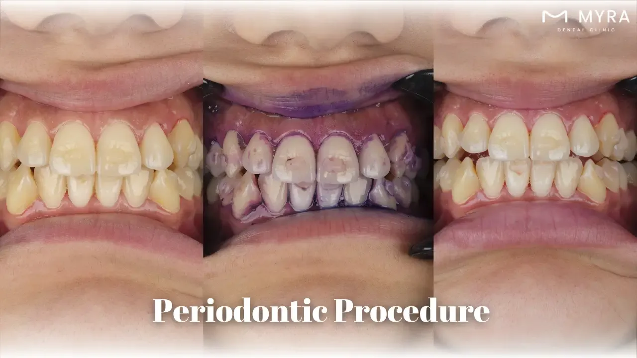 What to expect after a periodontic procedure in turkey