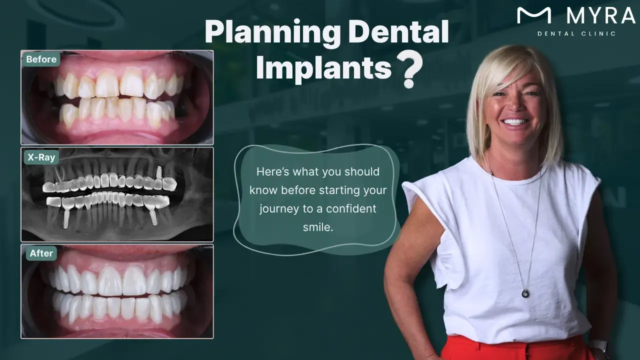 what to know before getting dental implants