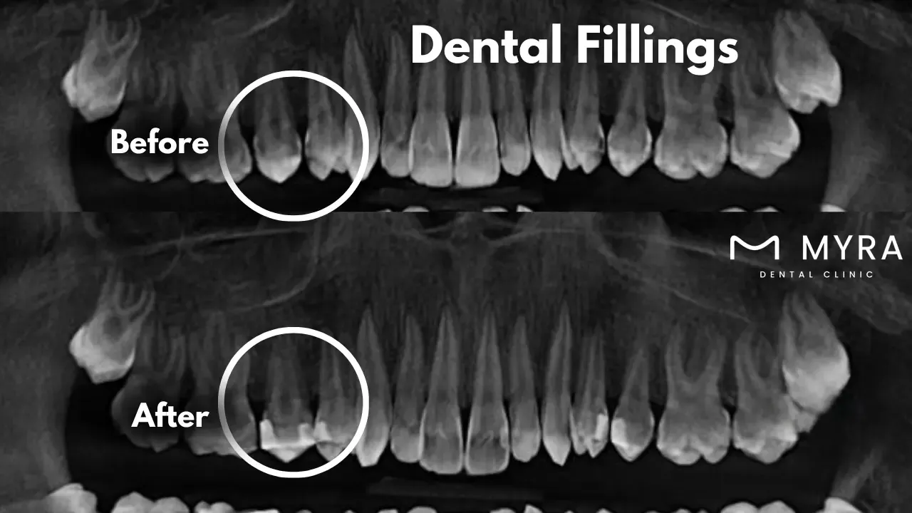 When are dental fillings needed in turkey?