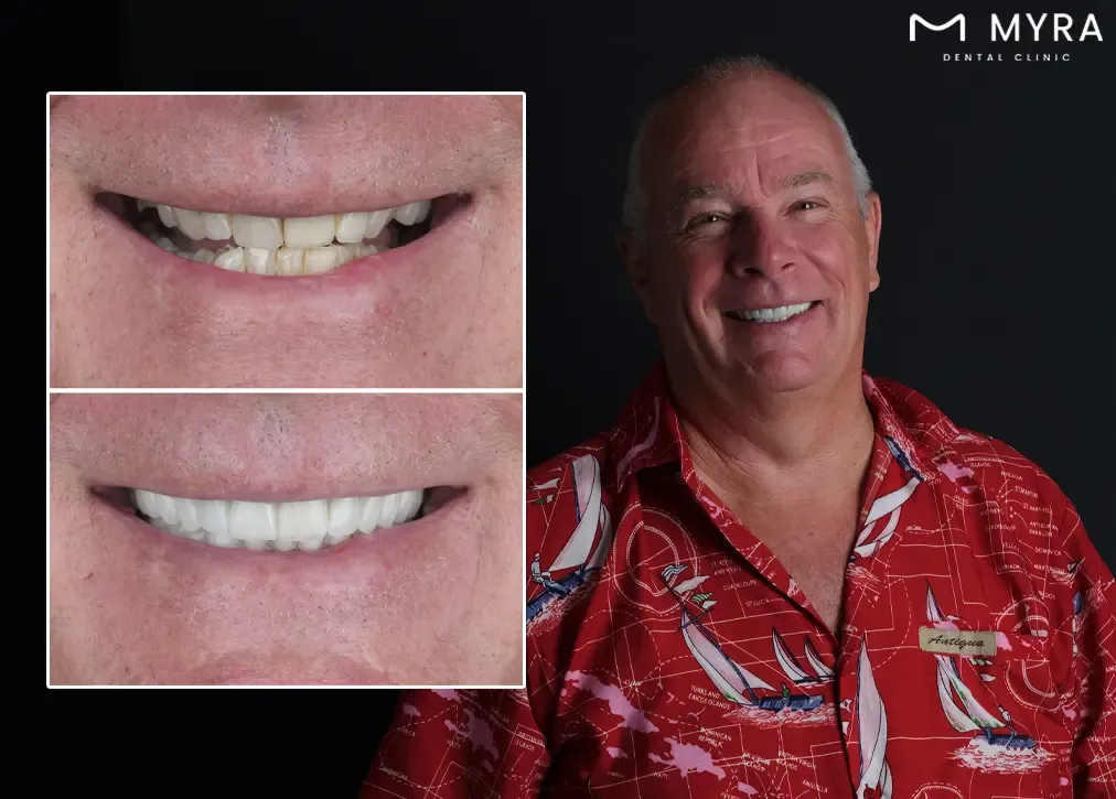 When does the dentist recommend zirconia veneers to their clients