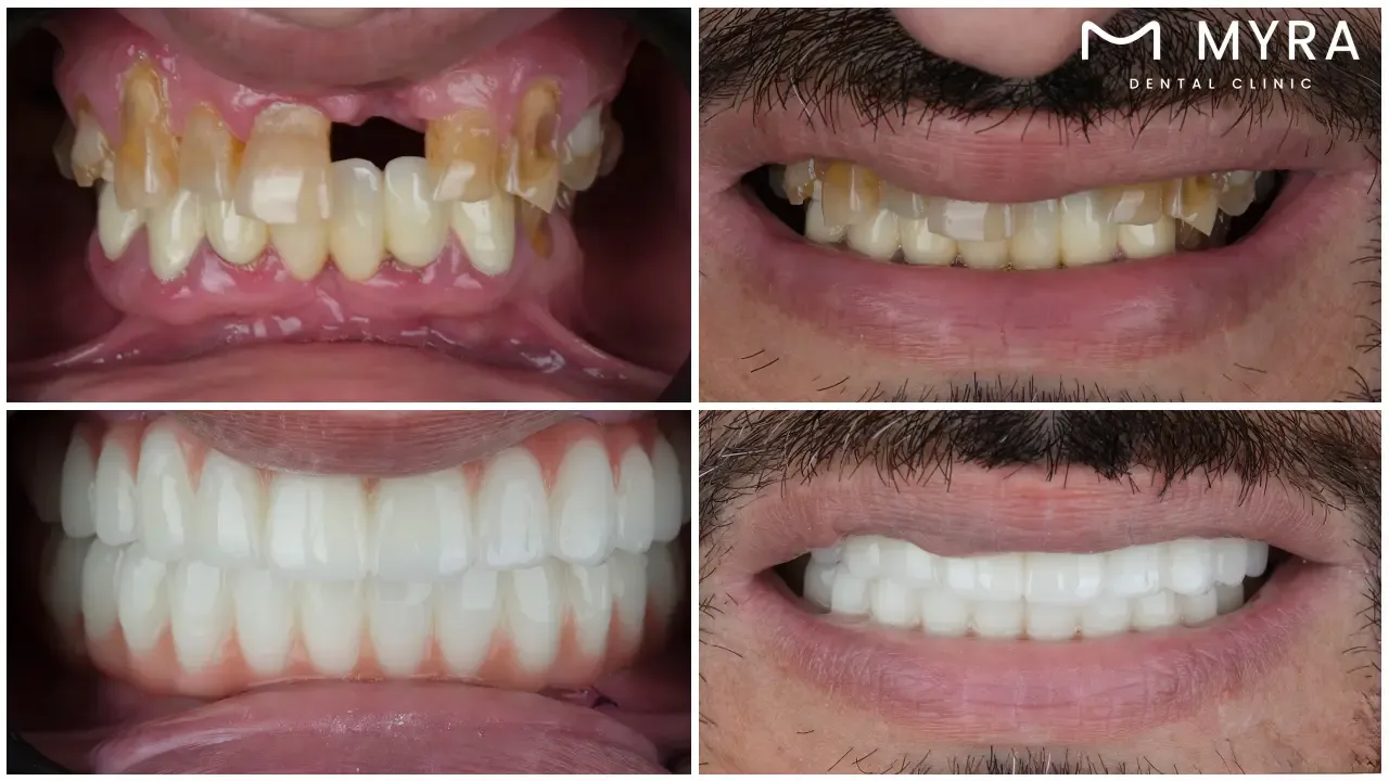 when is a denture needed?