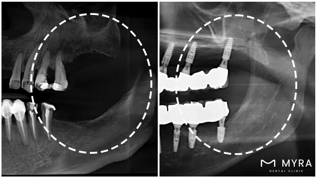 when is xenograft tissue needed in dentistry?