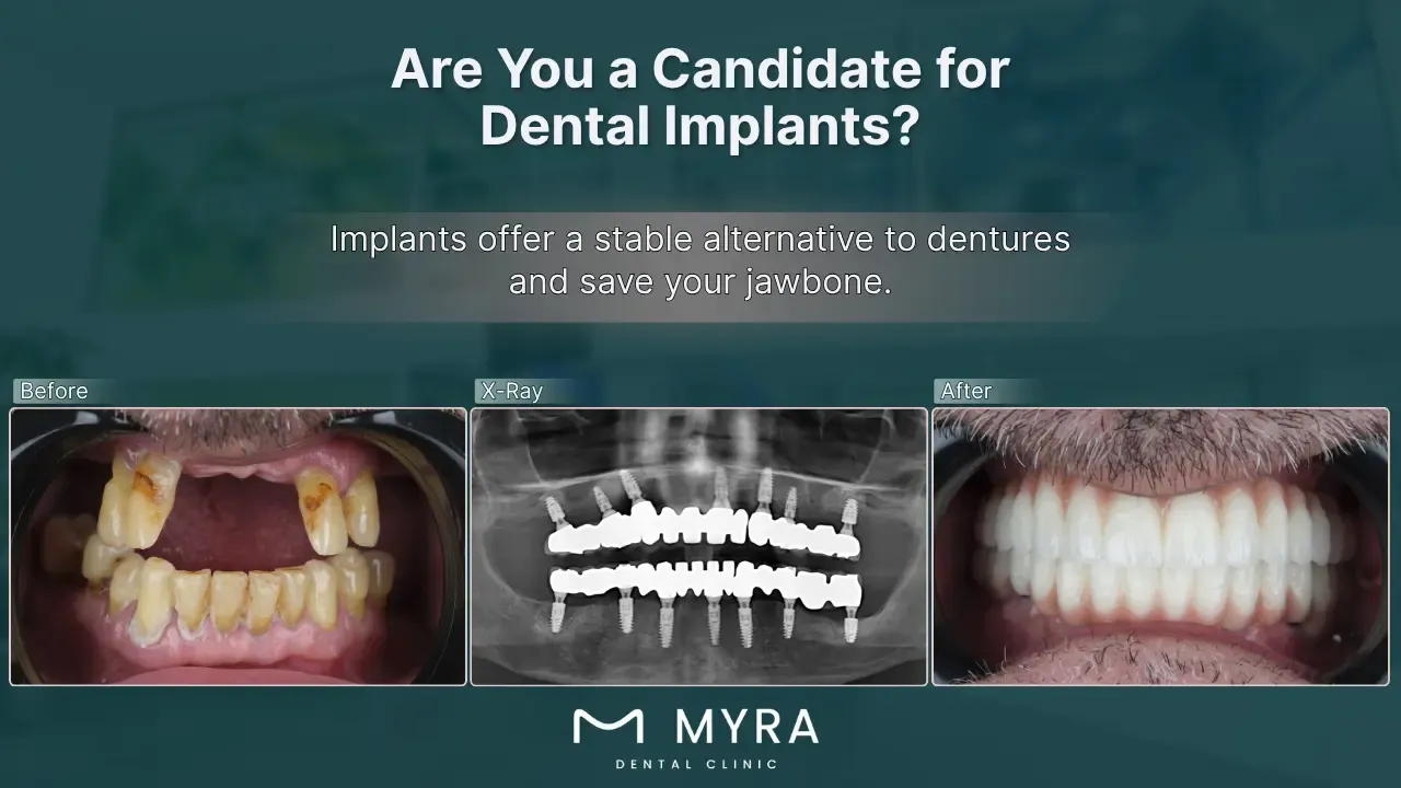 who-needs-a-dental-implant.webp