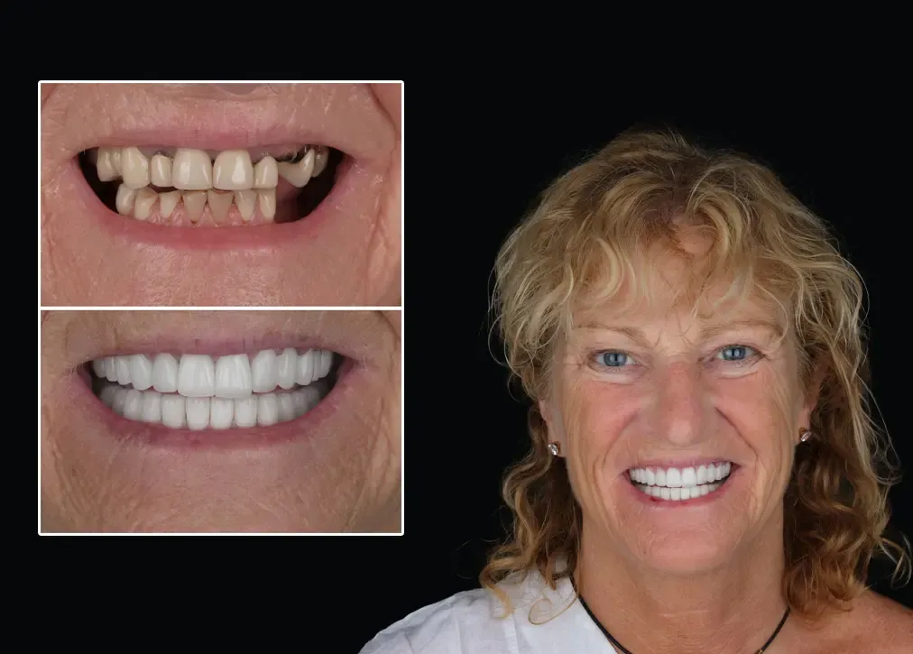 Why are root canal treatments important in turkey?