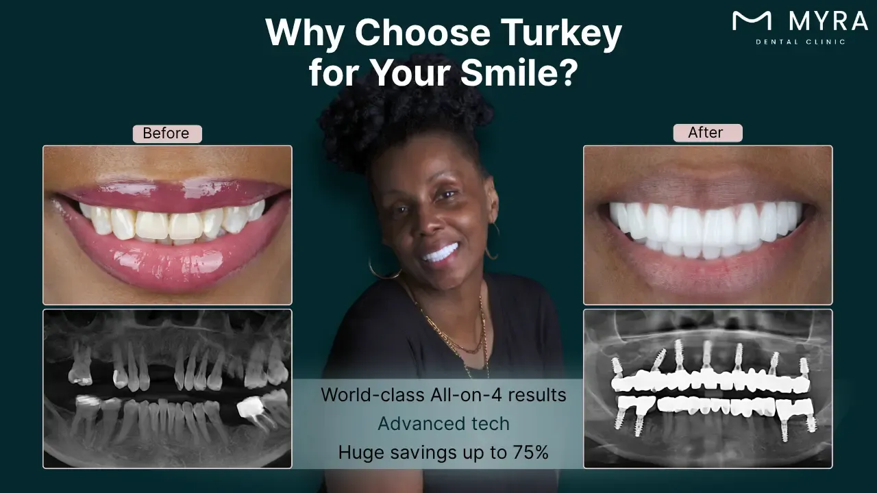 why-choose-turkey-for-getting-all-on-4-dental-implants.webp