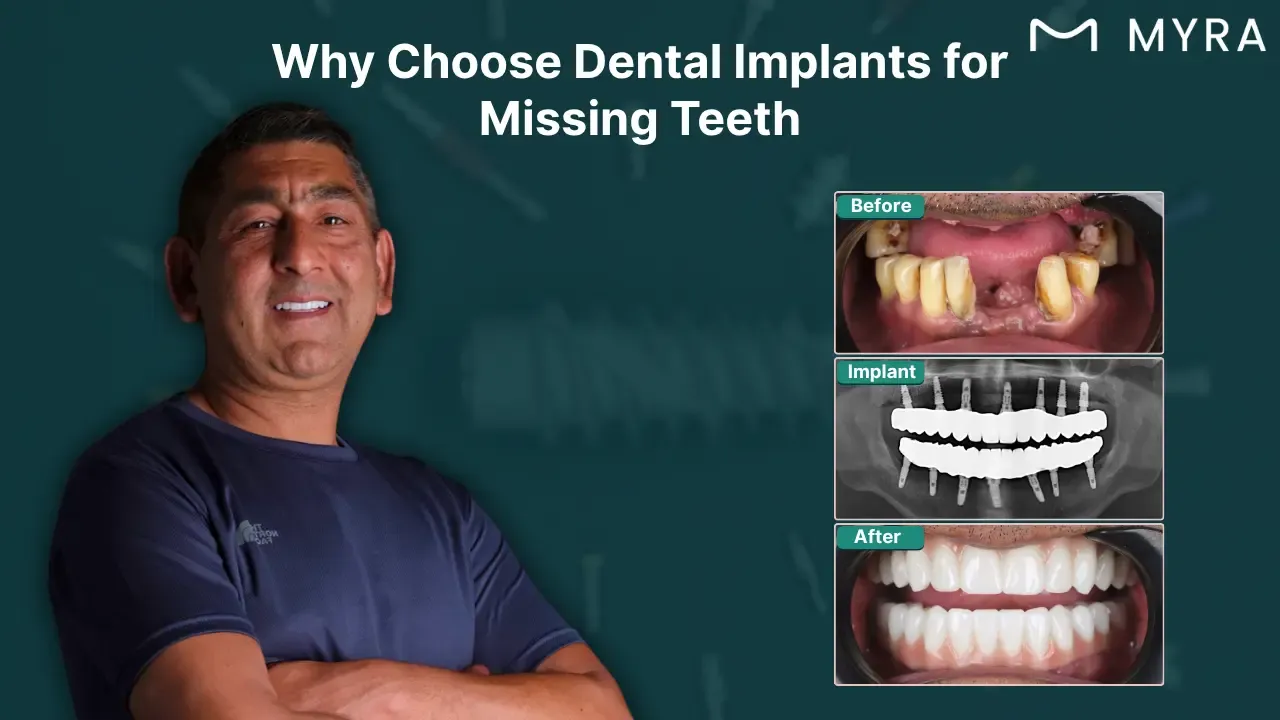 why-get-dental-implants.webp