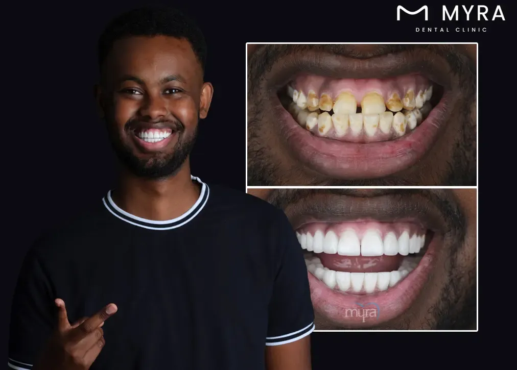 Why is gum contouring important in turkey?