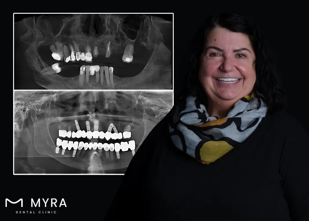 Why is tooth extraction important in turkey?