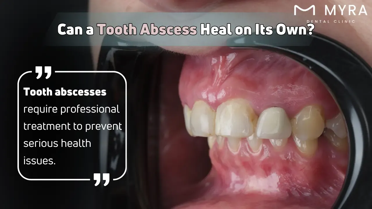 Will a tooth abscess heal by itself?