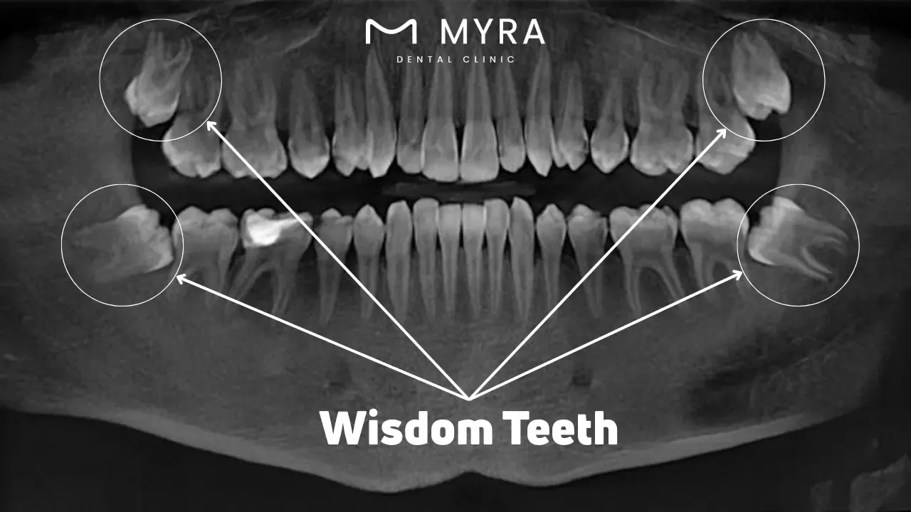 Wisdom teeth: Symptoms, complications, and treatment