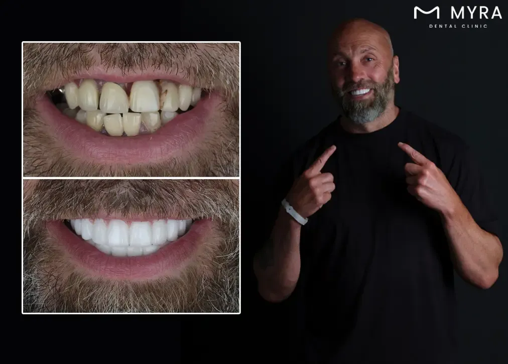 Zirconia veneers: Definition, importance, types, procedure and advantages