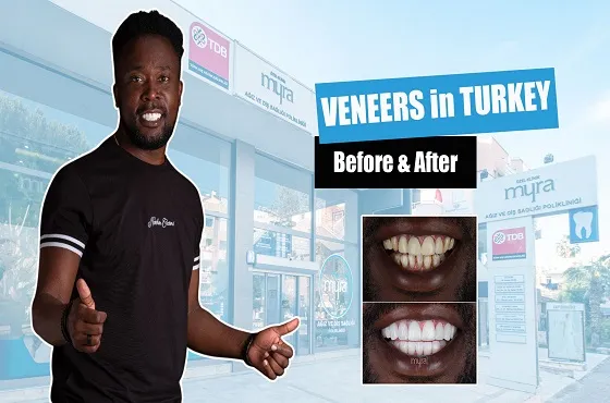 Myra Dental Centre Turkey -  Veneers Turkey