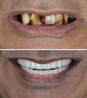 All-on-implants-turkey-missing-full -mouth-reconstruction-teeth-B1-zirconium