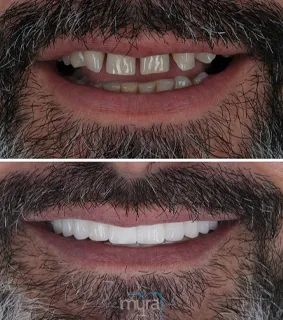 All-on-seven-dental-implants-turkey-missing-teeth-zirconium