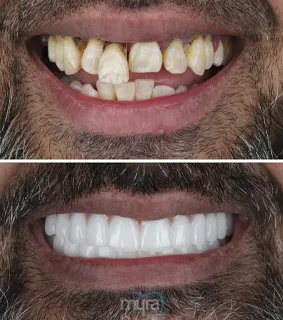 All-on-six-dental-implants-turkey-missing-teeth-zirconium-BL2