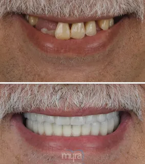 All-on-six-dental-implants-turkey-missing-teeth-zirconium