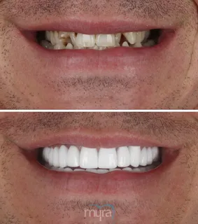 Crowns-turkey-in-turkey-hollywood-smile-teeth-BL0-zirconium